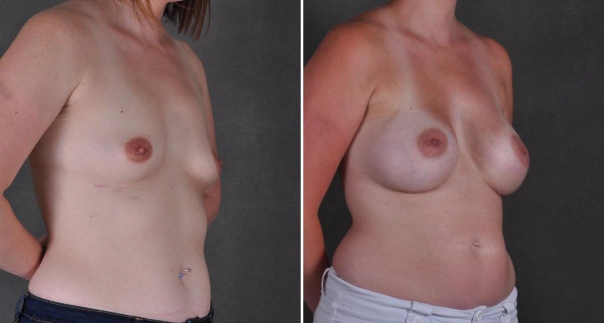 Breast Augmentation Before and After Photos in Omaha, NE, Case 9370