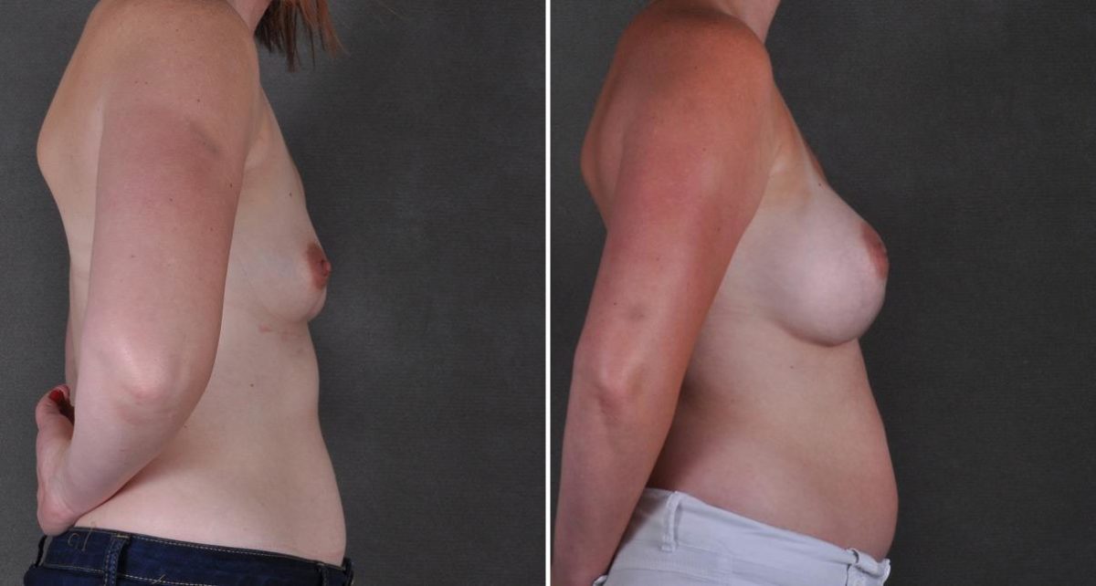 Breast Augmentation Before and After Photos in Omaha, NE, Case 9370