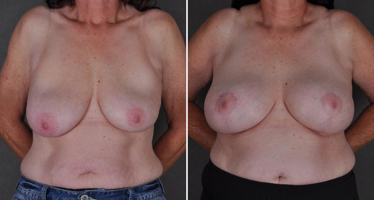 Case 9498, Breast Augmentation Before and After Photos Breast Augmentation Before and After Photos in Omaha, NE, Case 9498