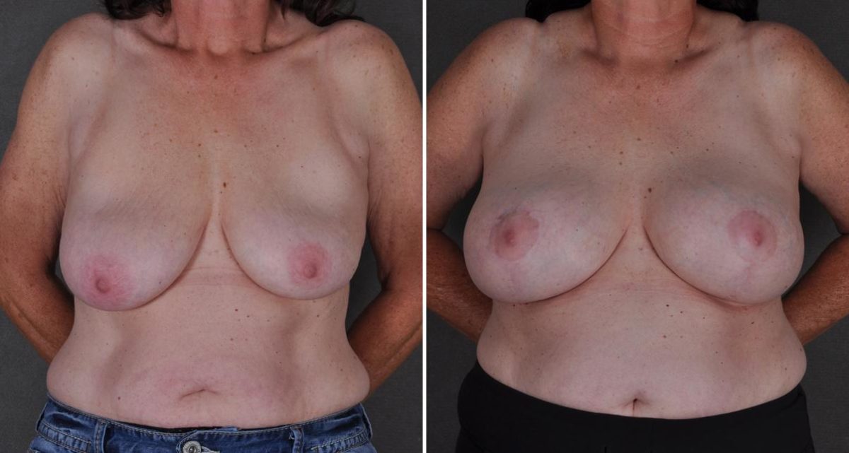 Breast Augmentation Before and After Photos in Omaha, NE, Case 9498