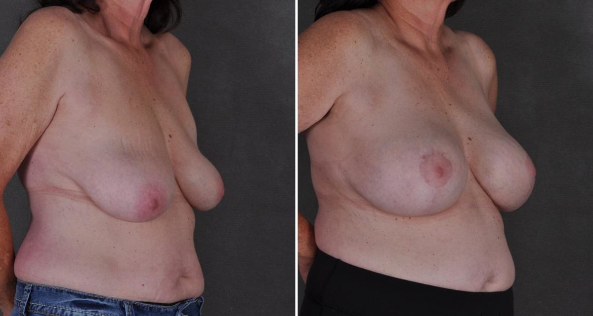 Breast Augmentation Before and After Photos in Omaha, NE, Case 9498