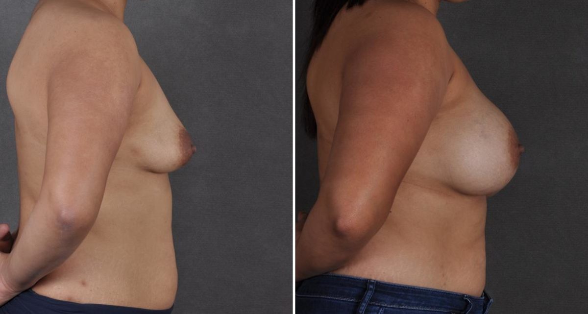 Breast Augmentation Before and After Photos in Omaha, NE, Case 9530