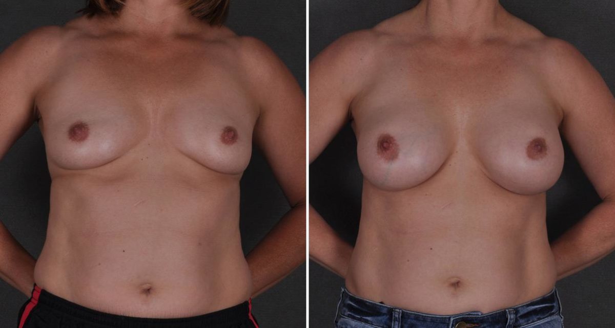 Breast Augmentation Before and After Photos in Omaha, NE, Case 9640