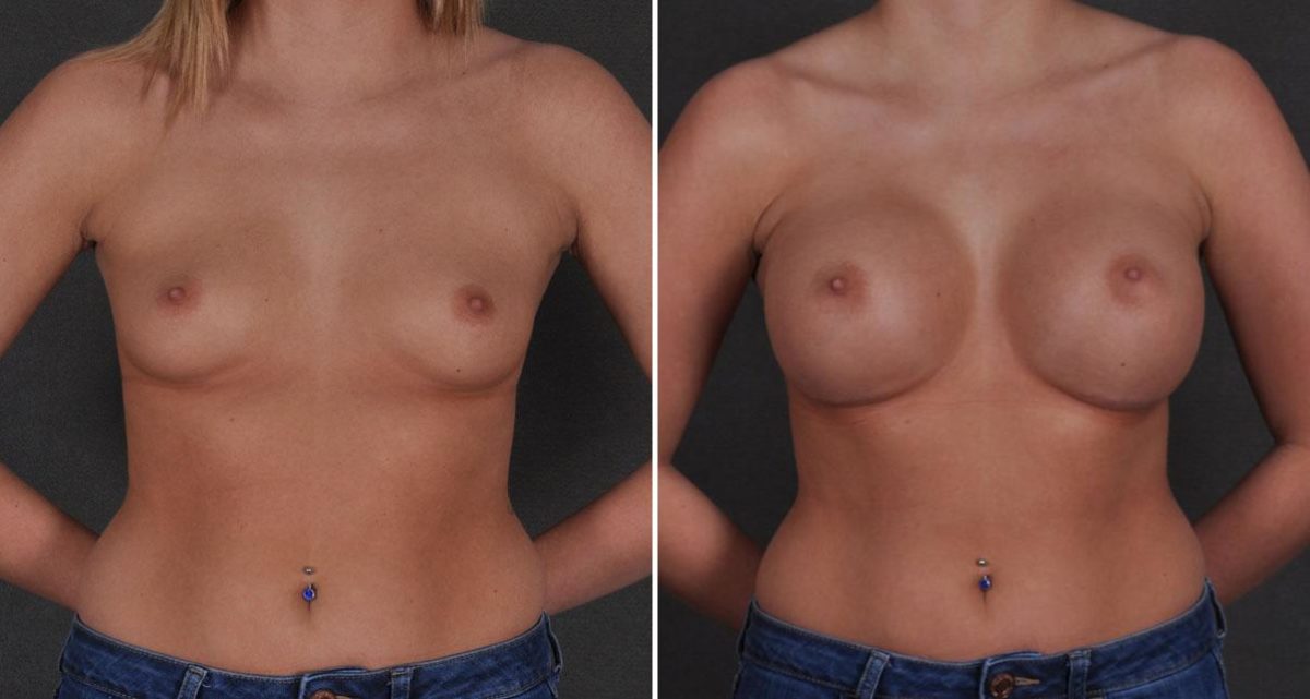 Breast Augmentation Before and After Photos in Omaha, NE, Case 9670