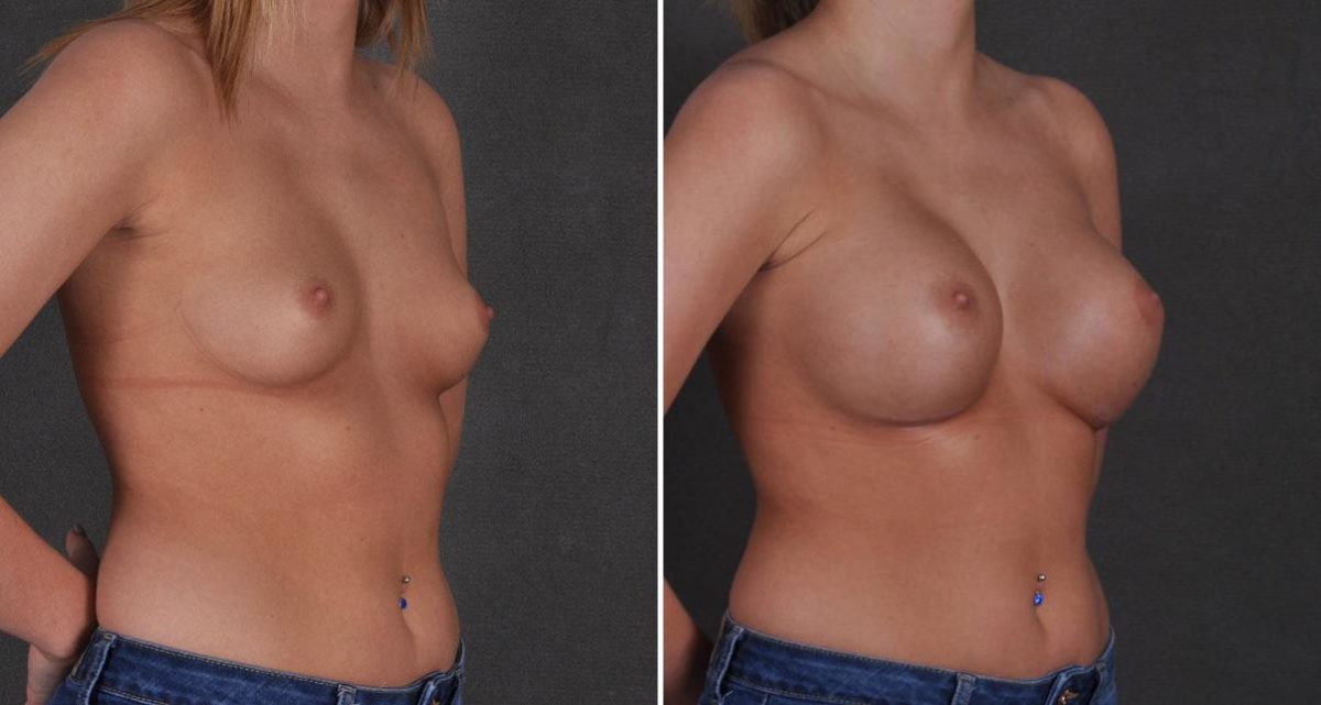 Breast Augmentation Before and After Photos in Omaha, NE, Case 9670