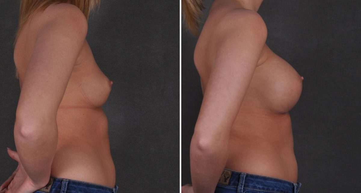 Breast Augmentation Before and After Photos in Omaha, NE, Case 9670