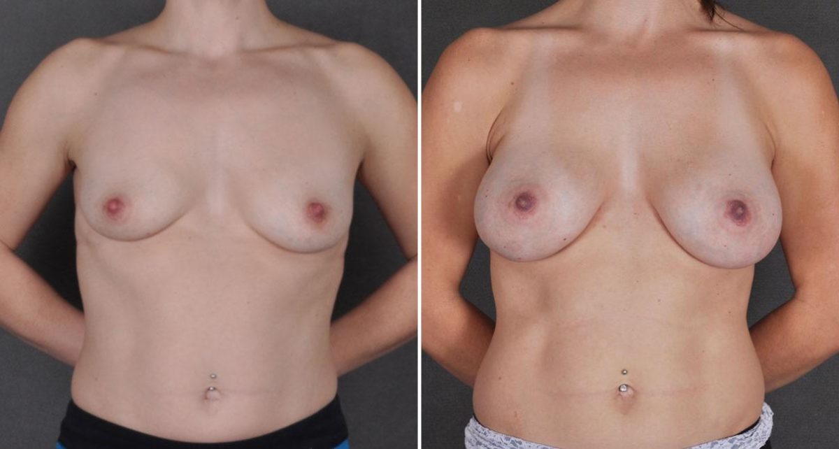 Breast Augmentation Before and After Photos in Omaha, NE, Case 9301