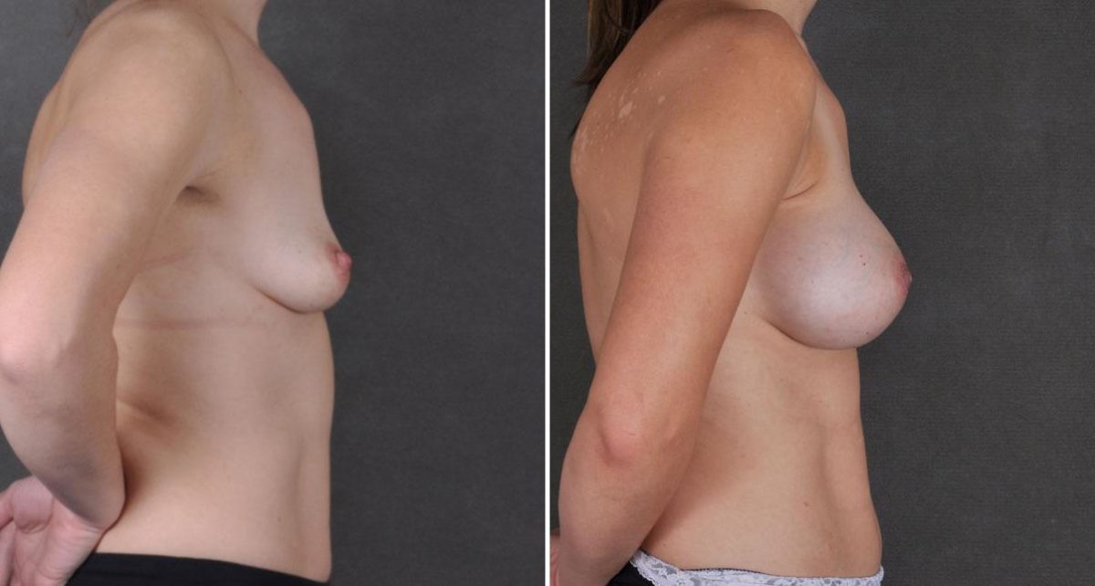 Breast Augmentation Before and After Photos in Omaha, NE, Case 9301