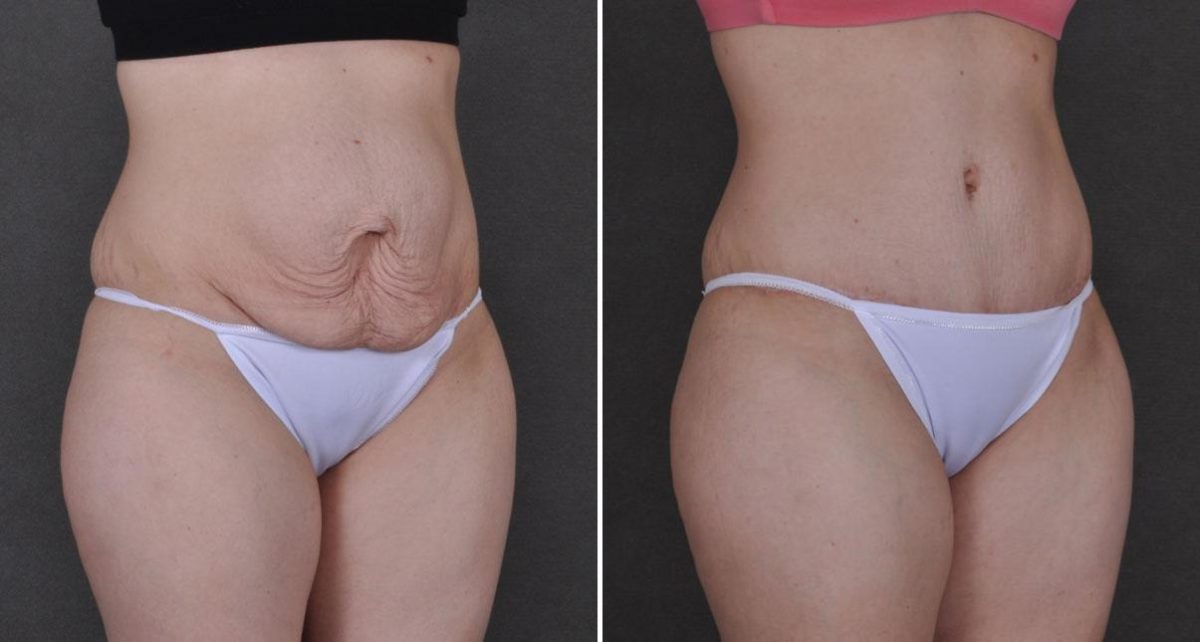 Tummy Tuck Before and After Photos in Omaha, NE, Case 9308