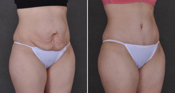 Tummy Tuck Before and After Photos in Omaha, NE, Case 9308