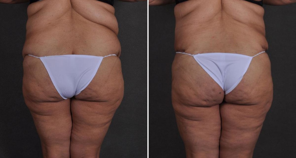 Case 9660, Tummy Tuck Before and After Photos Tummy Tuck Before and After Photos in Omaha, NE, Case 9660