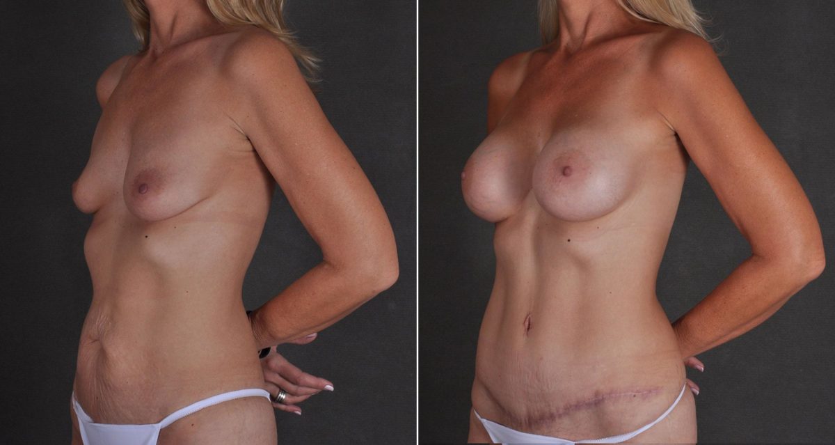 Tummy Tuck Before and After Photos in Omaha, NE, Case 9726