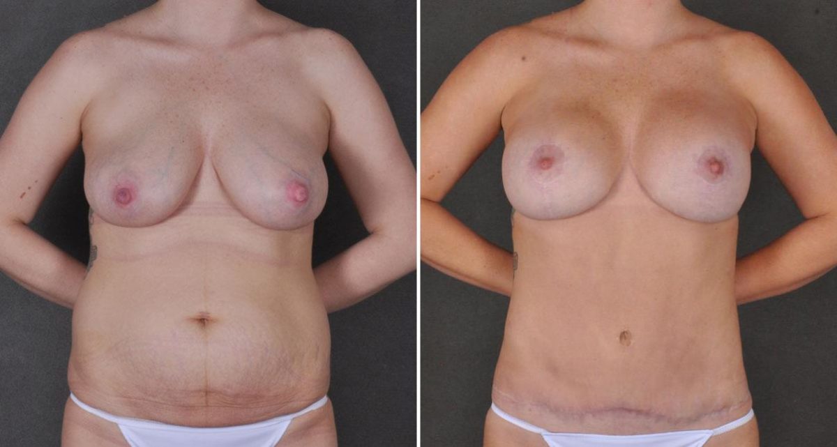 Case 9770, Tummy Tuck Before and After Photos Tummy Tuck Before and After Photos in Omaha, NE, Case 9770