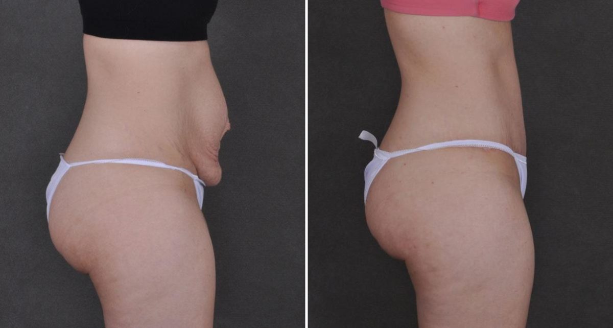 Tummy Tuck Before and After Photos in Omaha, NE, Case 9308