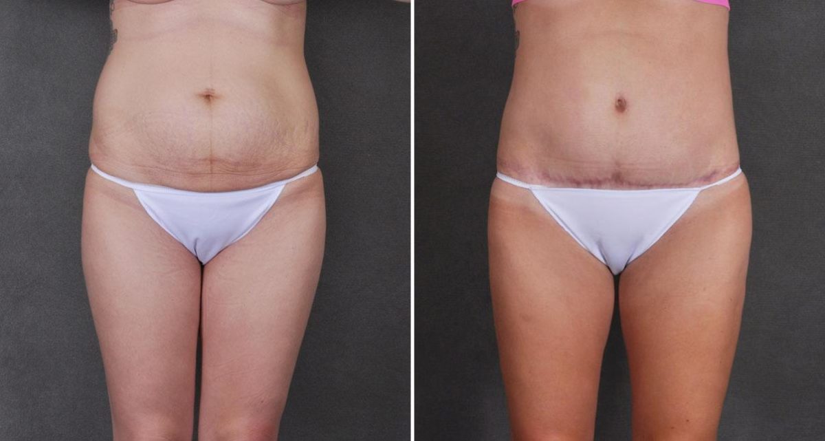 Tummy Tuck Before and After Photos in Omaha, NE, Case 9770