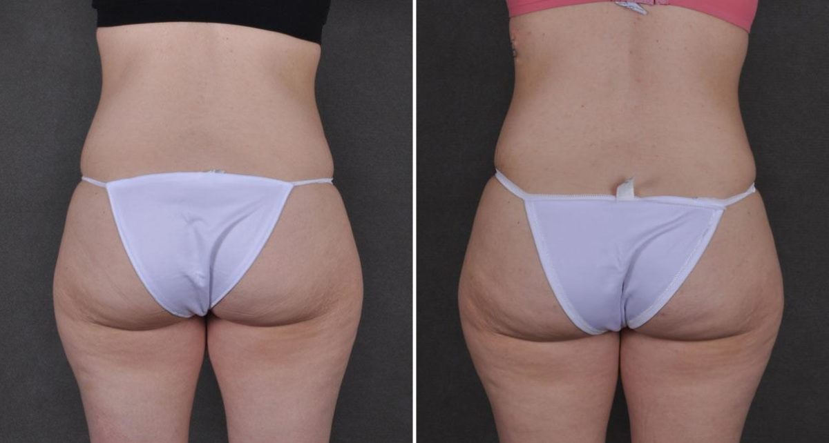 Tummy Tuck Before and After Photos in Omaha, NE, Case 9308