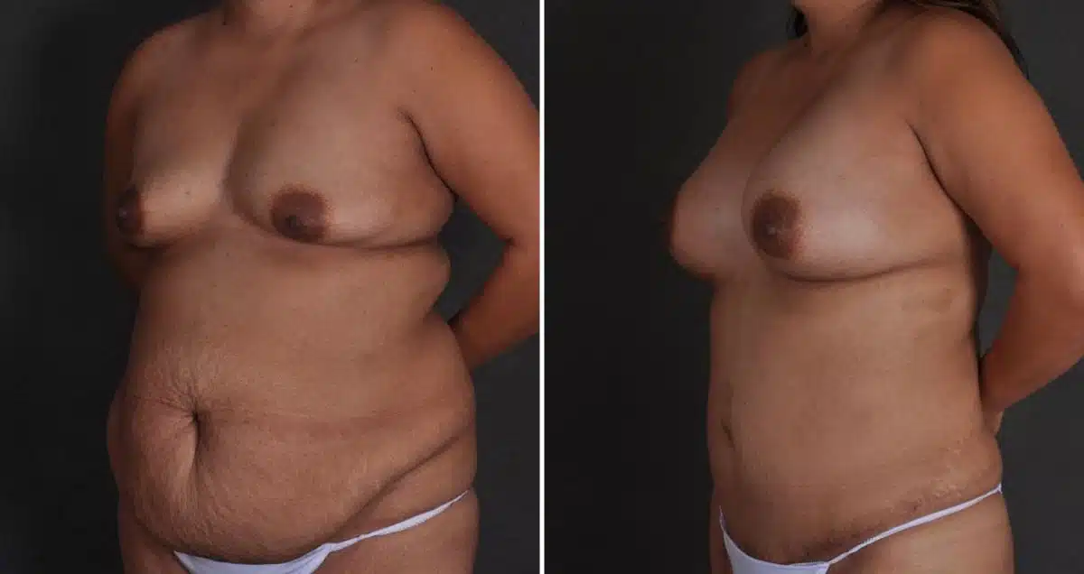 Tummy Tuck Before and After Photos in Omaha, NE, Case 9858