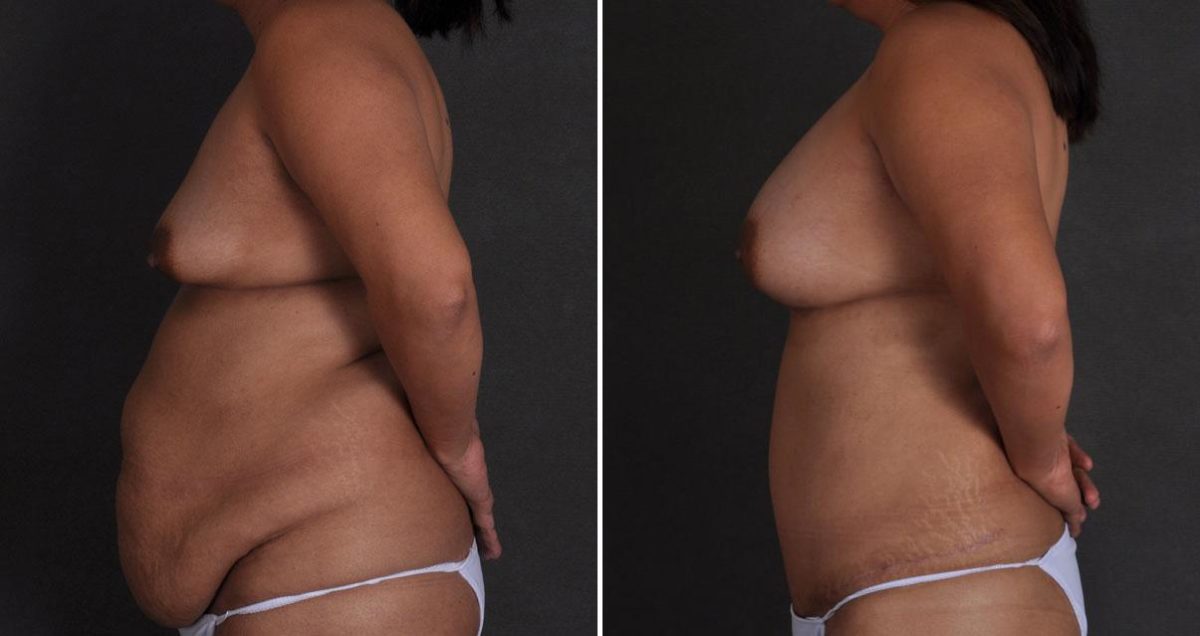 Tummy Tuck Before and After Photos in Omaha, NE, Case 9858