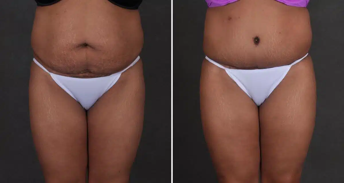 Tummy Tuck Before and After Photos in Omaha, NE, Case 9859