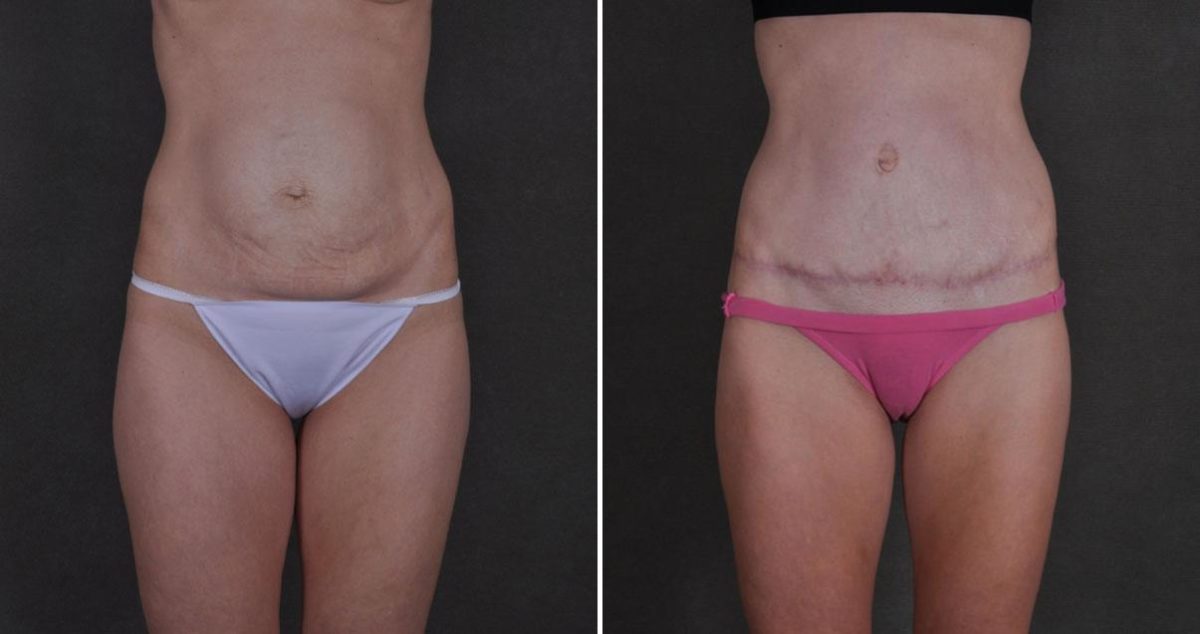 Case 9870, Tummy Tuck Before and After Photos Tummy Tuck Before and After Photos in Omaha, NE, Case 9870