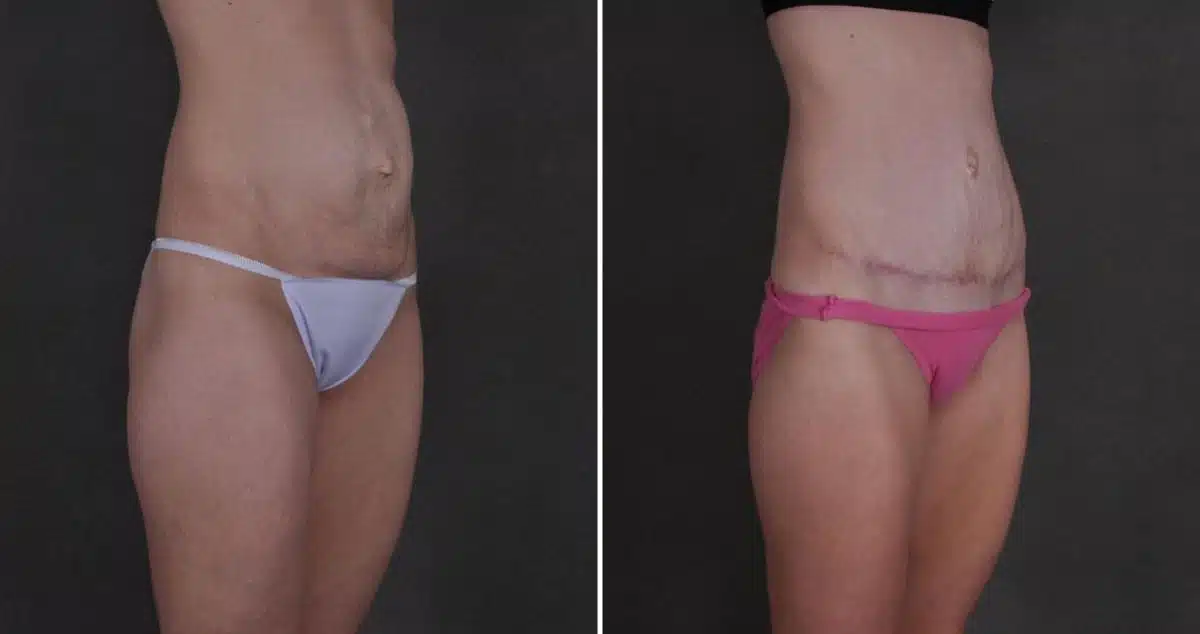 Case 9870, Tummy Tuck Before and After Photos Tummy Tuck Before and After Photos in Omaha, NE, Case 9870