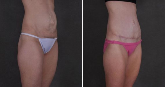 Tummy Tuck Before and After Photos in Omaha, NE, Case 9870