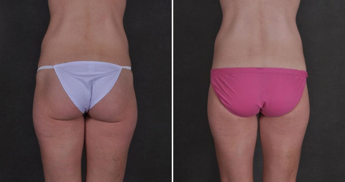 Case 9870, Tummy Tuck Before and After Photos Tummy Tuck Before and After Photos in Omaha, NE, Case 9870