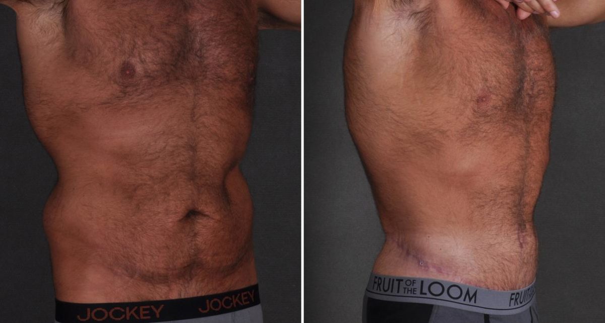 Tummy Tuck Before and After Photos in Omaha, NE, Case 9436