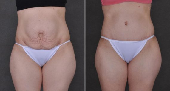 Tummy Tuck Before and After Photos in Omaha, NE, Case 9308