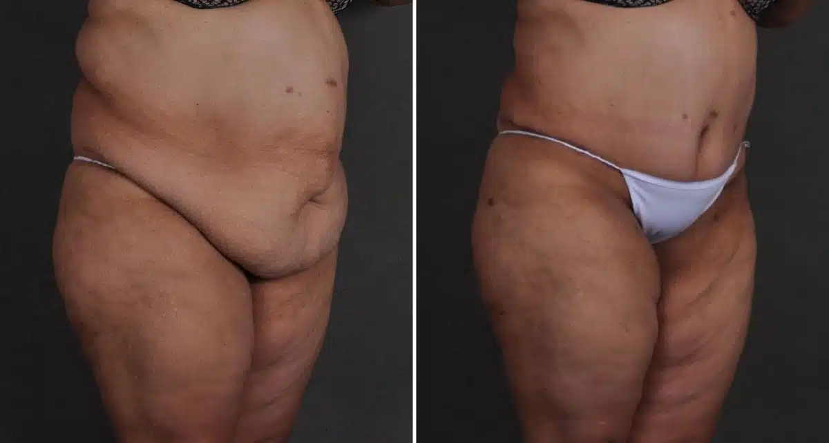 Case 9660, Tummy Tuck Before and After Photos Tummy Tuck Before and After Photos in Omaha, NE, Case 9660