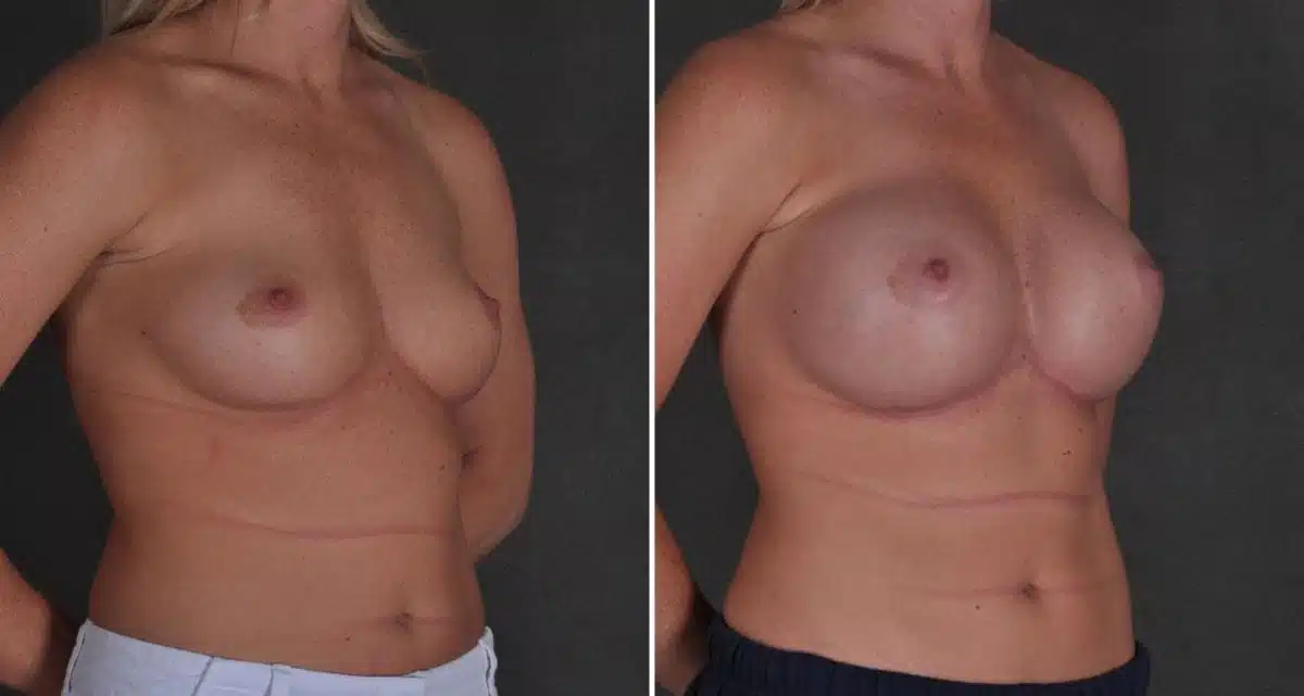 Breast Augmentation Before and After Photos in Omaha, NE, Case 9677