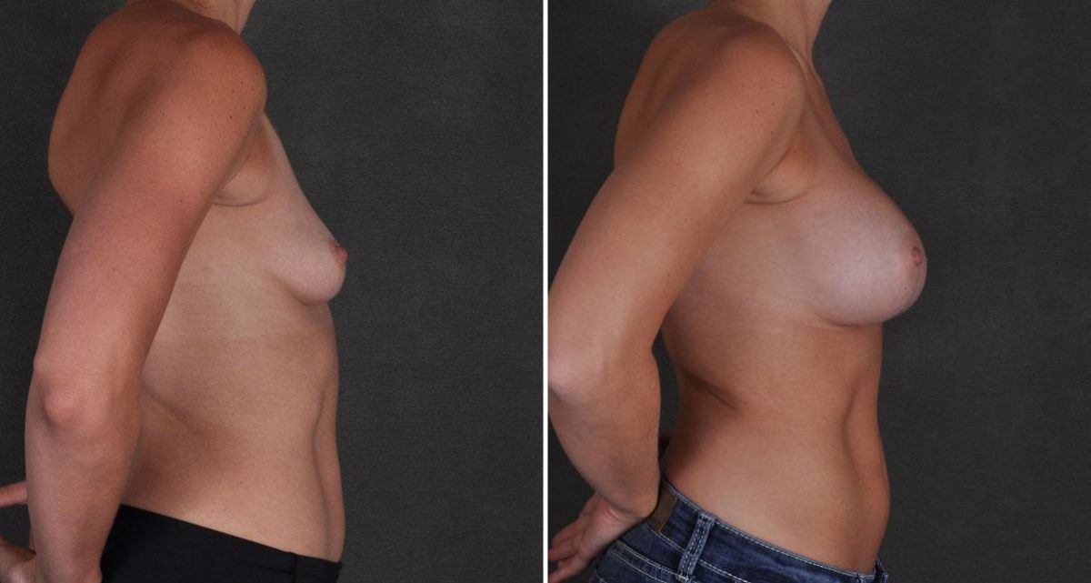 Case 9684, Breast Augmentation Before and After Photos Breast Augmentation Before and After Photos in Omaha, NE, Case 9684