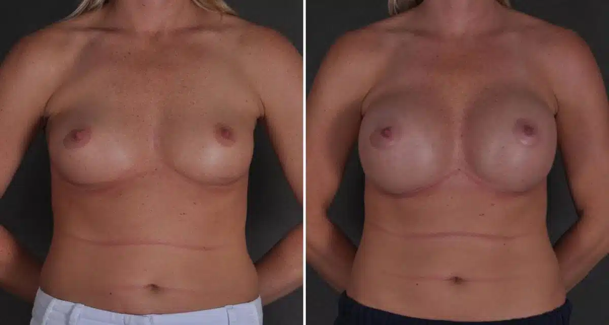 Breast Augmentation Before and After Photos in Omaha, NE, Case 9677