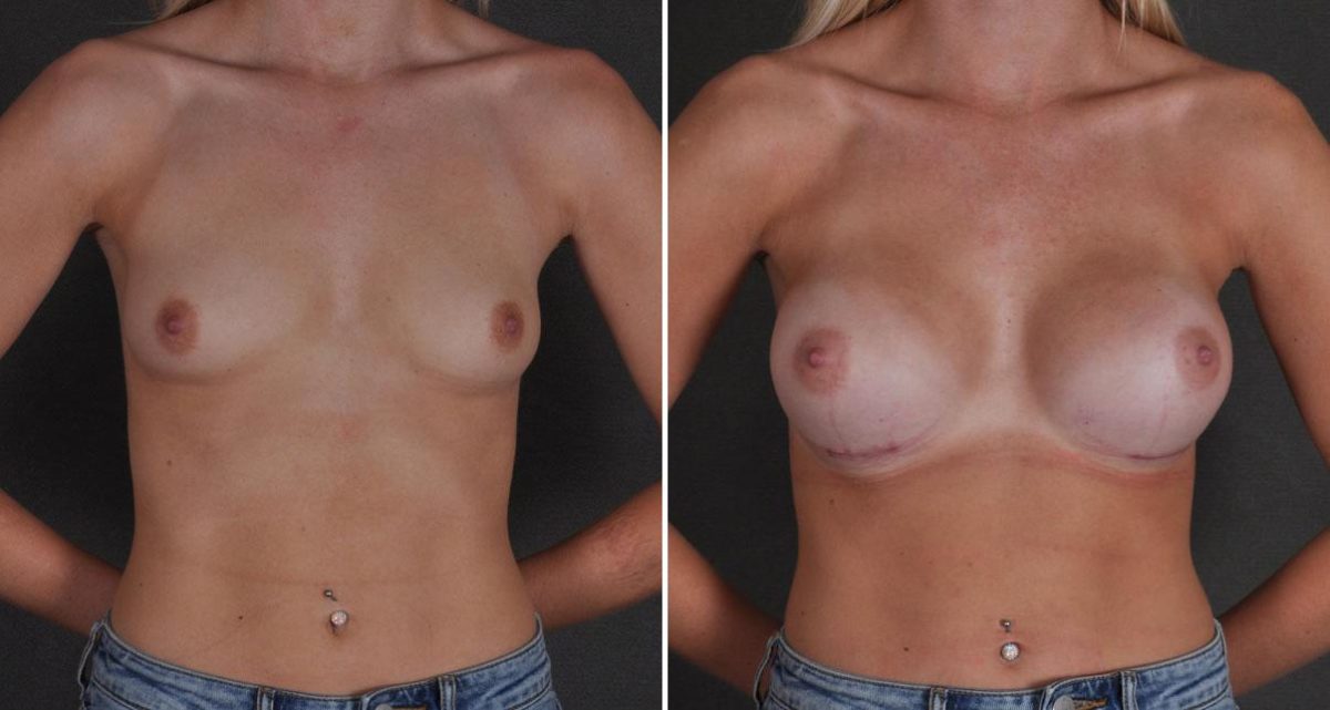 Breast Augmentation Before and After Photos in Omaha, NE, Case 9691