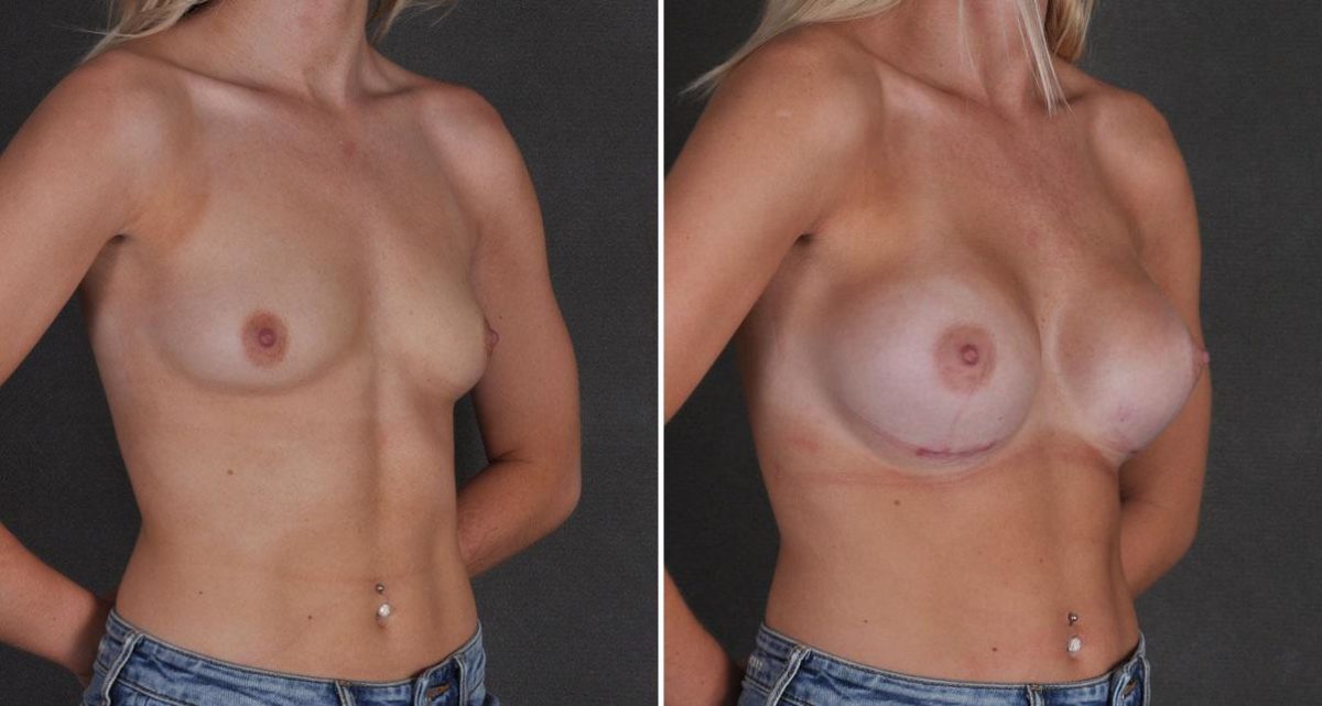 Breast Augmentation Before and After Photos in Omaha, NE, Case 9691