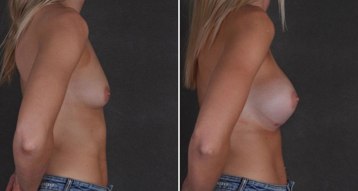 Breast Augmentation Before and After Photos in Omaha, NE, Case 9691