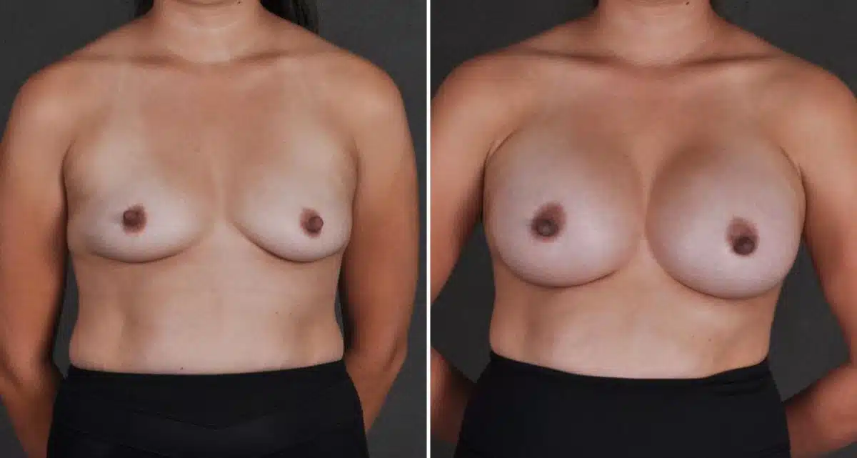 Case 9698, Breast Augmentation Before and After Photos Breast Augmentation Before and After Photos in Omaha, NE, Case 9698