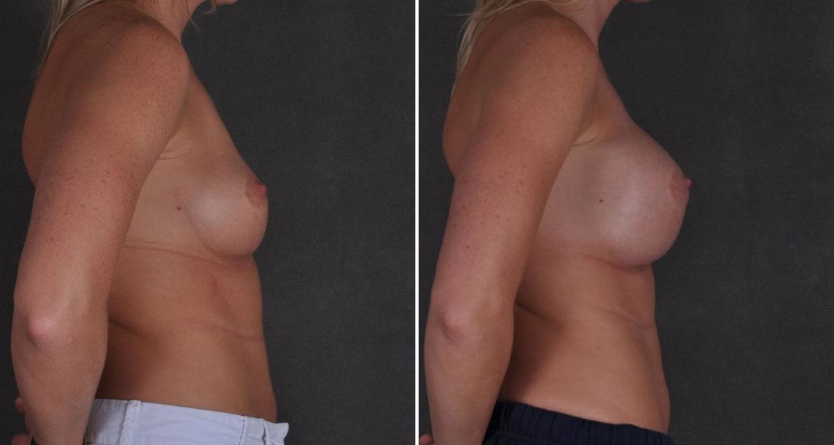 Breast Augmentation Before and After Photos in Omaha, NE, Case 9677