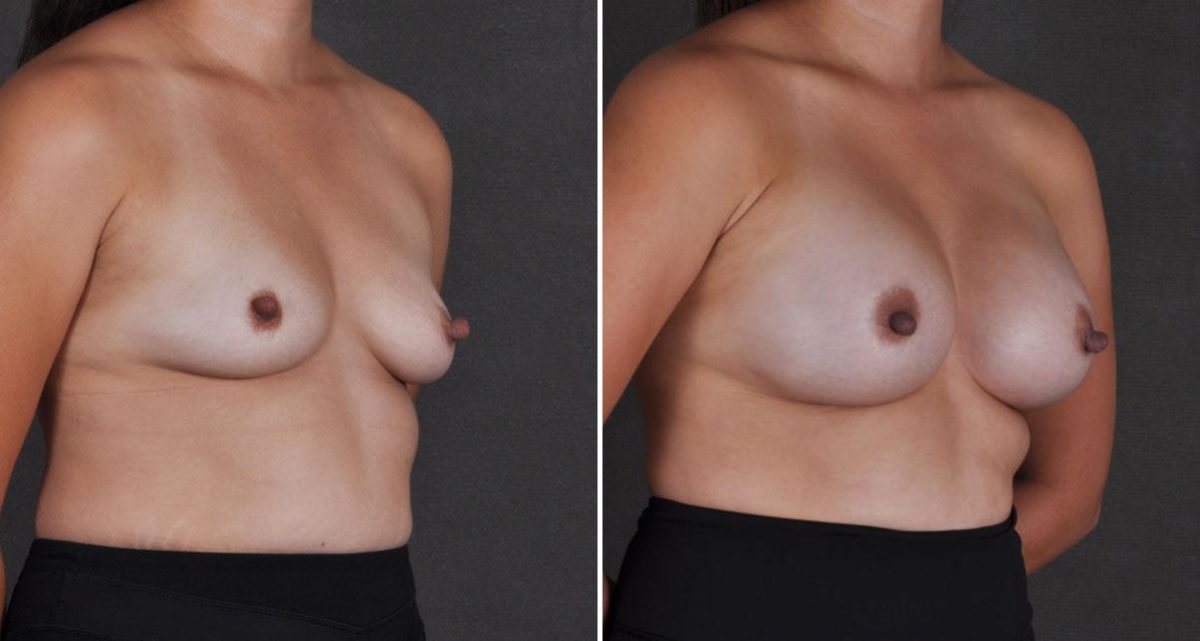 Breast Augmentation Before and After Photos in Omaha, NE, Case 9698