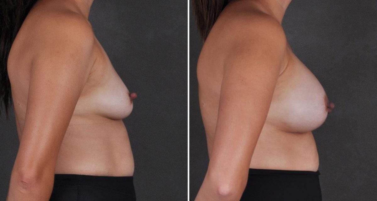 Breast Augmentation Before and After Photos in Omaha, NE, Case 9698