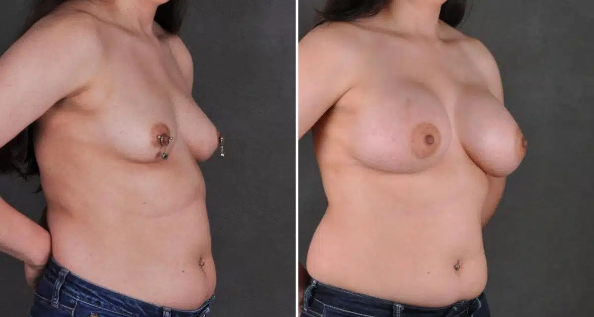 Breast Augmentation Before and After Photos in Omaha, NE, Case 9705