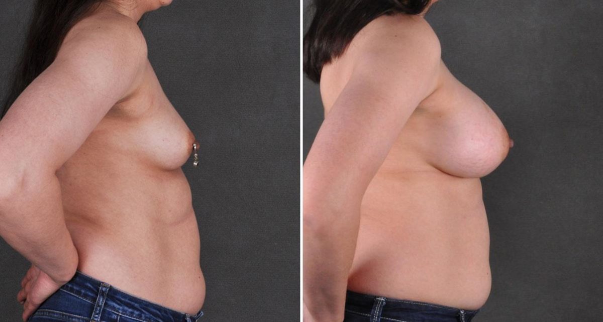 Breast Augmentation Before and After Photos in Omaha, NE, Case 9705