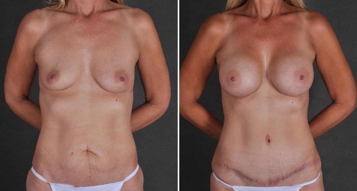 Breast Augmentation Before and After Photos in Omaha, NE, Case 9719