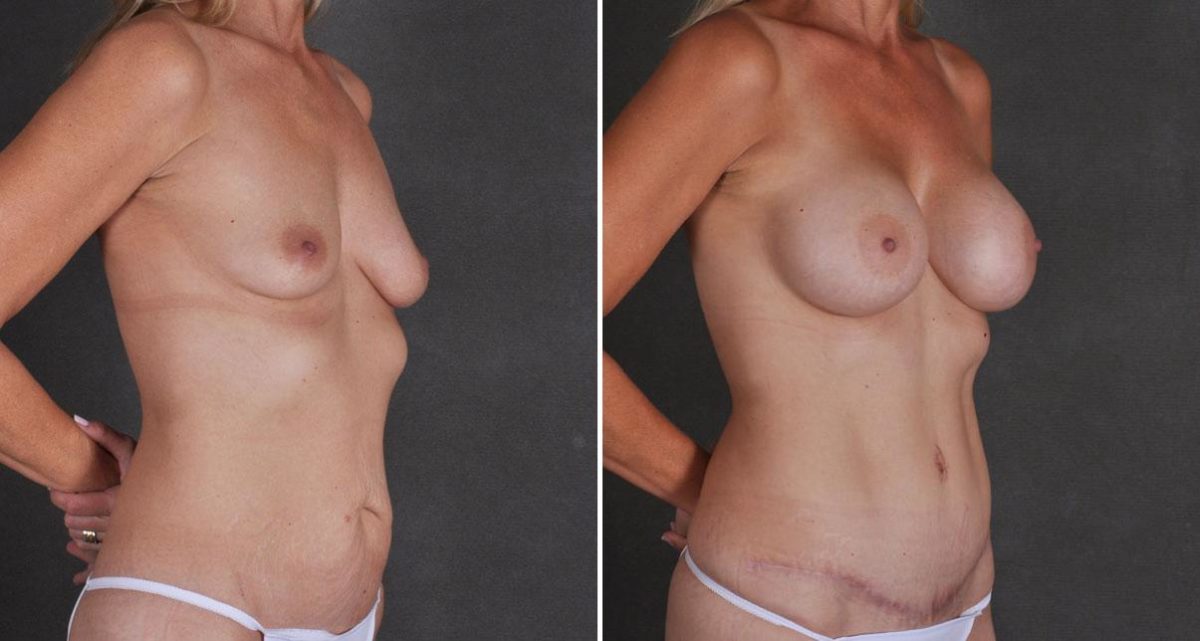 Breast Augmentation Before and After Photos in Omaha, NE, Case 9719