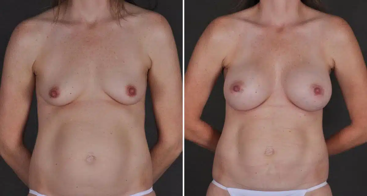 Breast Augmentation Before and After Photos in Omaha, NE, Case 9783