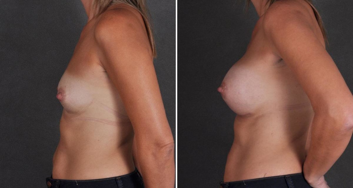 Breast Augmentation Before and After Photos in Omaha, NE, Case 9808