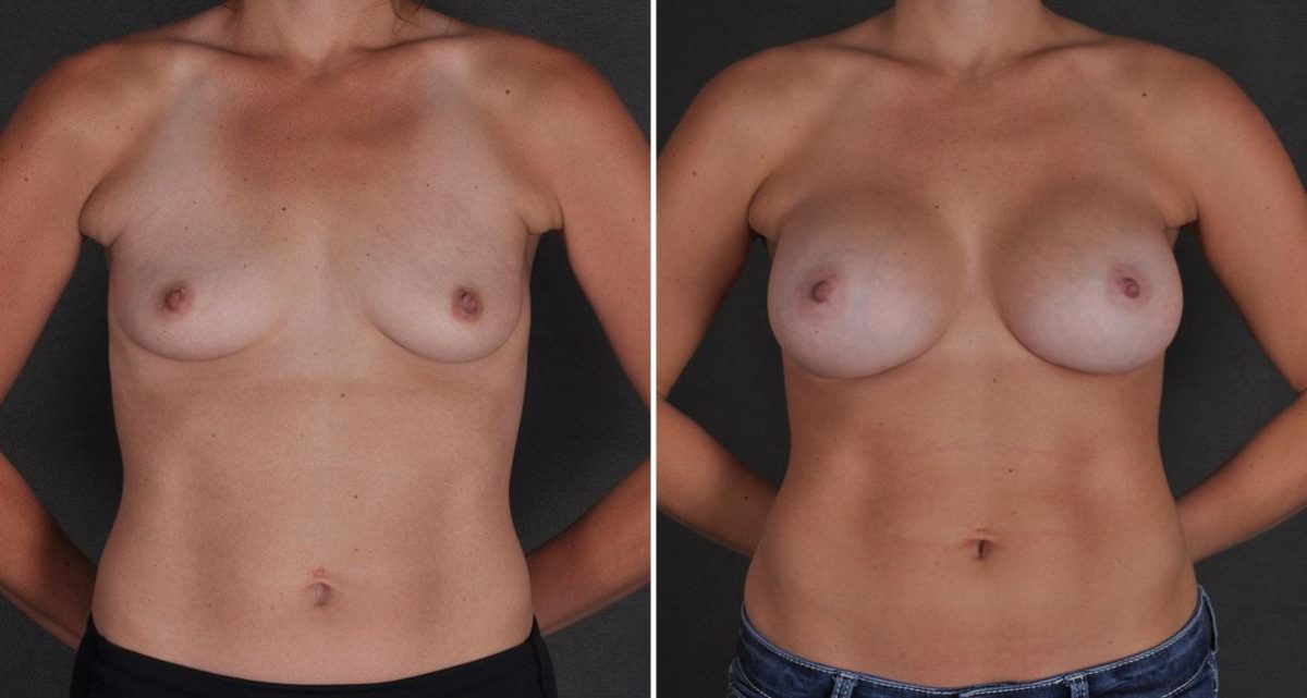 Breast Augmentation Before and After Photos in Omaha, NE, Case 9684