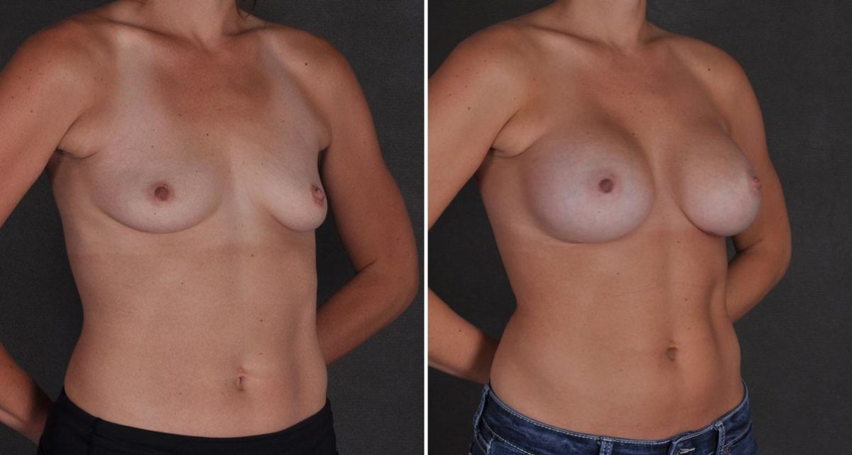 Breast Augmentation Before and After Photos in Omaha, NE, Case 9684