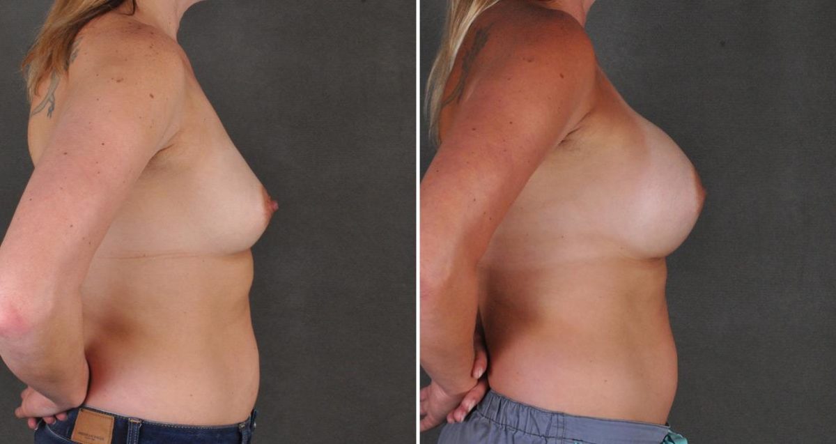 Breast Augmentation Before and After Photos in Omaha, NE, Case 10309