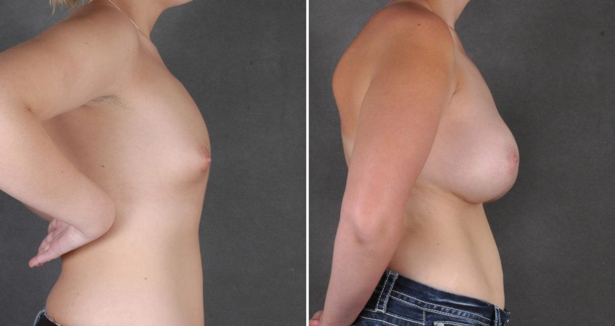 Breast Augmentation Before and After Photos in Omaha, NE, Case 10310